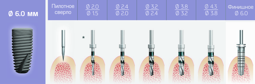 Протокол установки имплантата дентиум. Келлер имплантаци. Можно ли ставит импланты при диабете. Можно ли ставит импланты при диабете. Больно ли вставлять импланты.