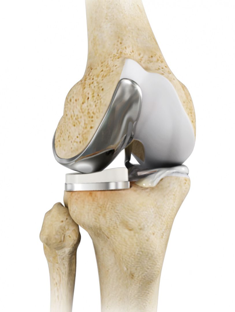 unicompartmental-knee-replacement.jpg