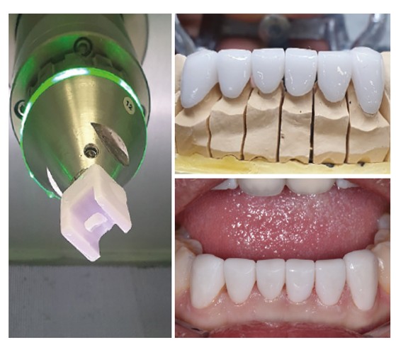 Veneer laminate.jpg Veneer laminate.jpg