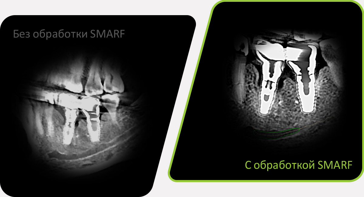 SMARF - алгоритм уменьшения вторичного улучшения от металлов дентального компьютерного 3D томографа.jpg