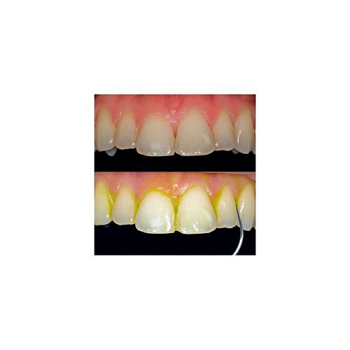 Acteon Newtron P5 B.LED - ультразвуковой скалер c технологией B.LED и жидким индикатором для обнаружения зубных отложений F.L.A.G