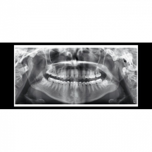 Planmeca ProOne - универсальный цифровой ортопантомограф
