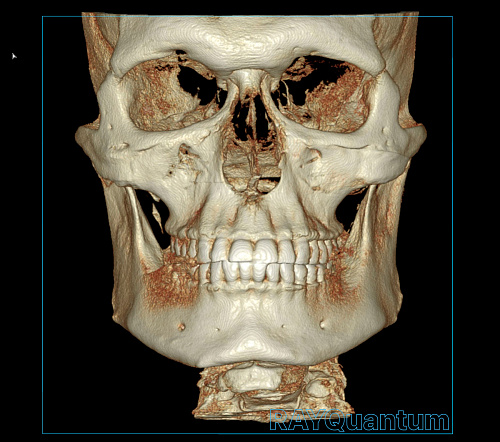 Ray α-SM3D Quantum – Дентальный томограф с цефалостатом