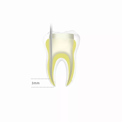 DTE Fi-G — Обтуратор гуттаперчи
